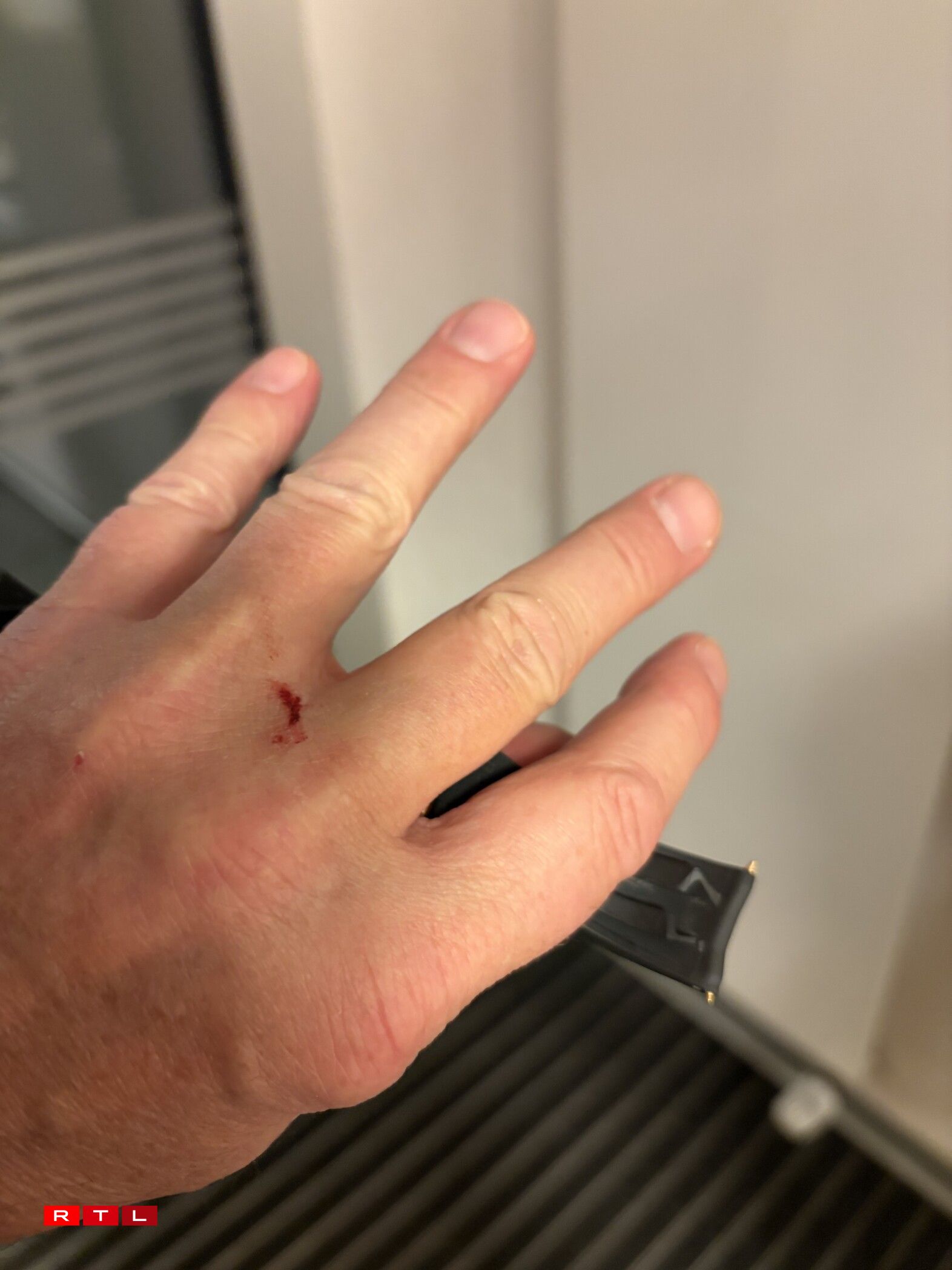 Hei gesäit een d'Verletzung un der Hand vum Affer.