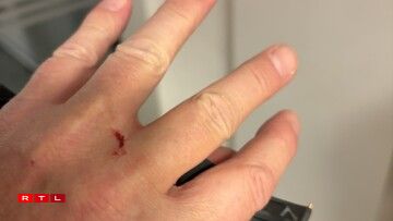 Hei gesäit een d'Verletzung un der Hand vum Affer.